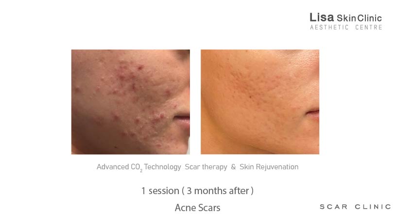 Lisa skin clinic, Calicut, Scar therapy